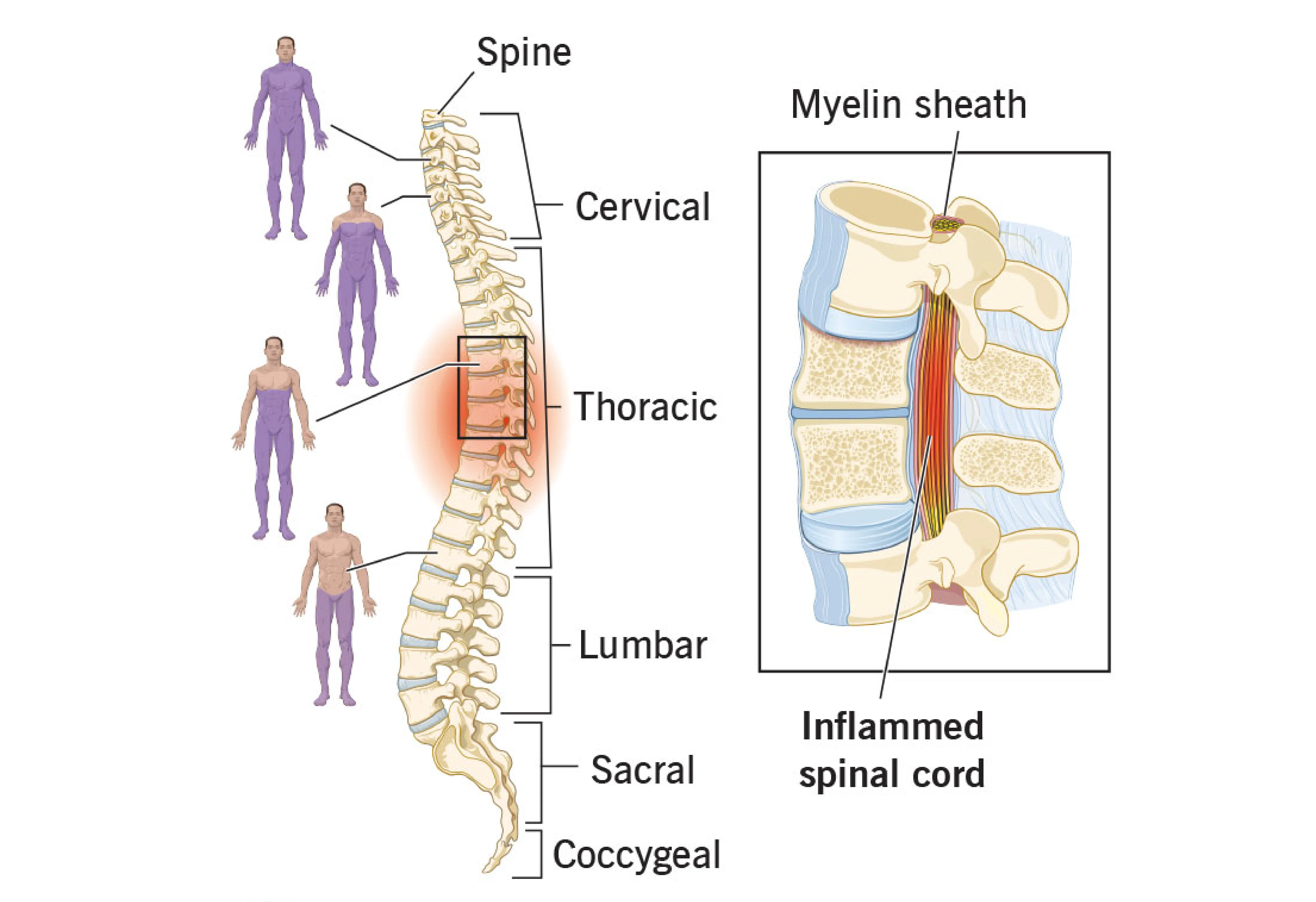 Early Signs of Spinal Disorders in Working Professionals